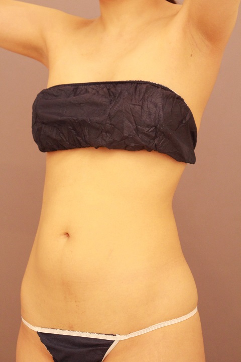 お腹のの脂肪吸引　３か月経過