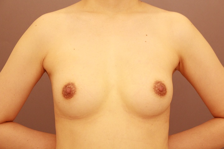 シリコンバック抜去＆コンデンスリッチ豊胸　１か月経過