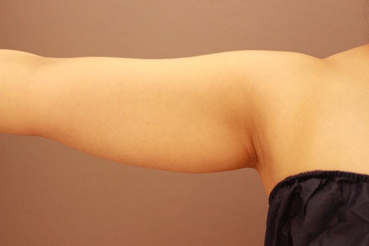 二の腕 脂肪吸引 半年経過