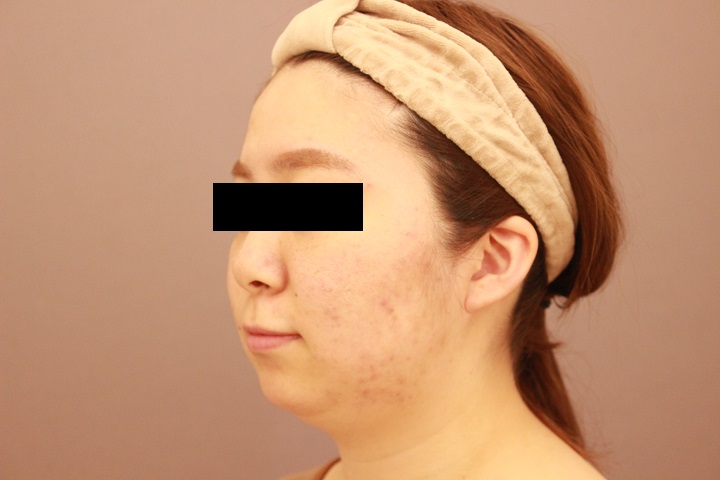 顔の脂肪吸引　３か月経過