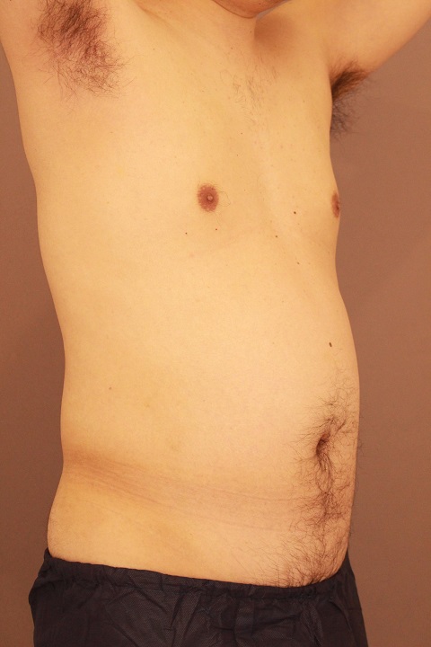 男性の腹部脂肪吸引　　半年経過
