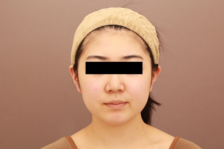 顔の脂肪吸引 半年経過