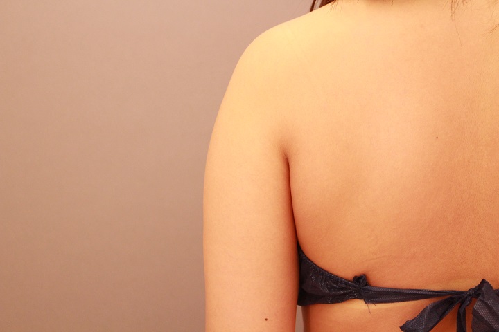 二の腕・肩 脂肪吸引 半年経過