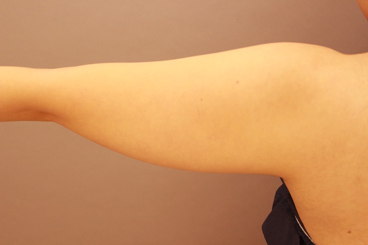二の腕・肩 脂肪吸引 半年経過