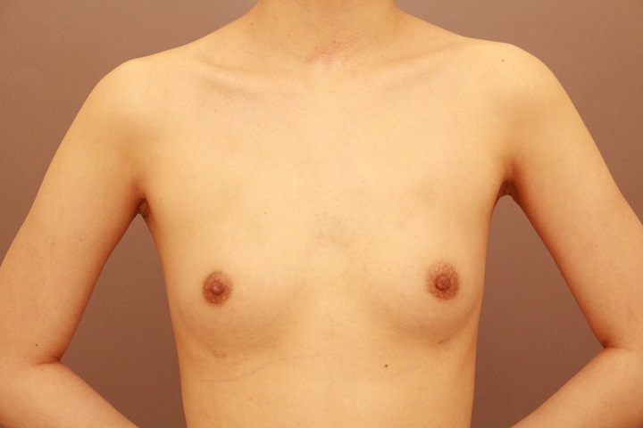 コンデンスリッチ豊胸　半年経過