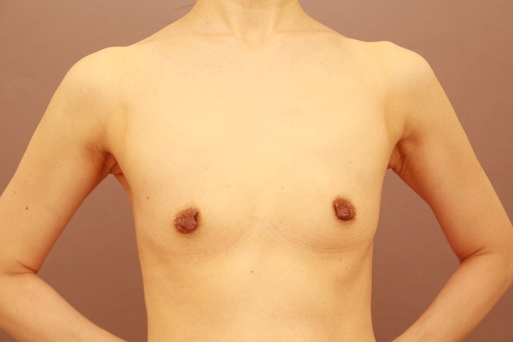 コンデンスリッチ豊胸＋乳首縮小　３か月経過