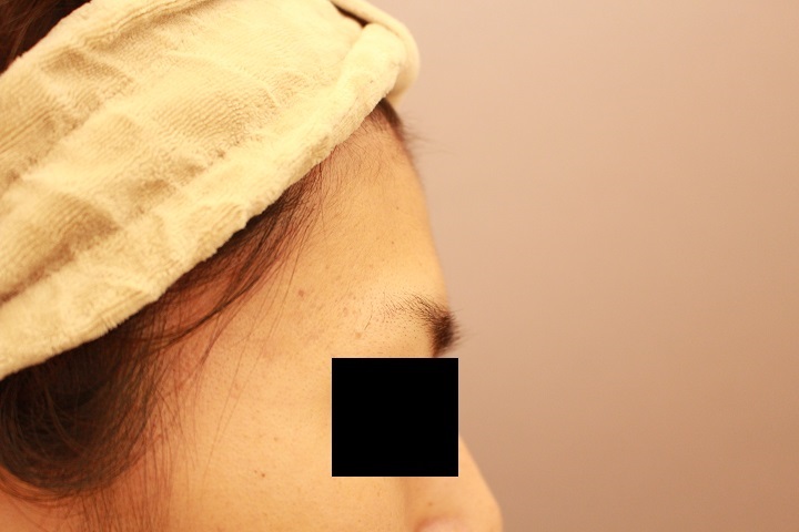 脂肪注入でおでこ（額）を丸く