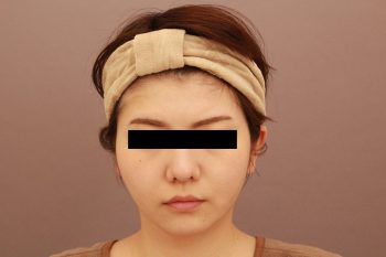 顔の脂肪吸引 半年経過