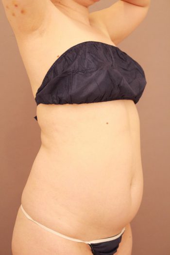 お腹の脂肪吸引　半年経過