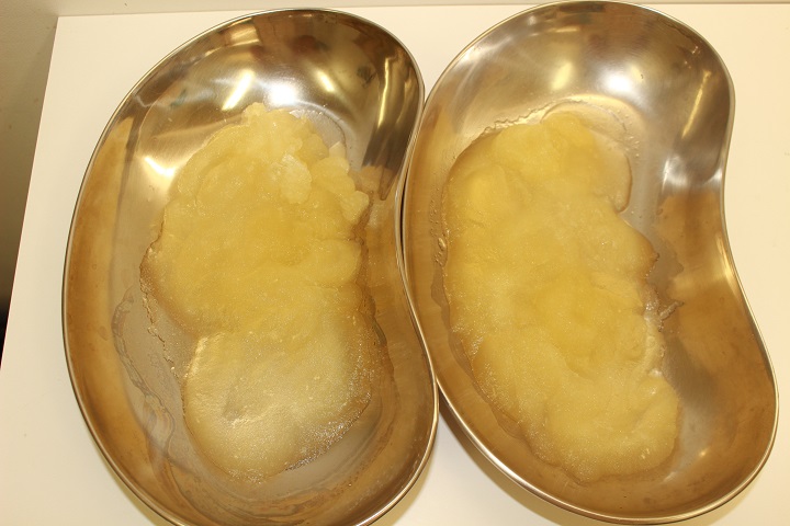 固くなってしまった胸からのヒアルロン酸除去